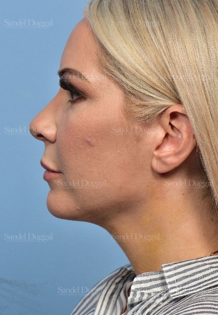 after chin liposuction side view female patient case 5315