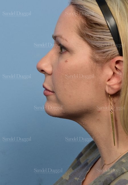 before chin liposuction side view female patient case 5315