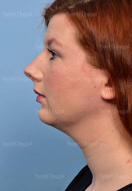 before chin liposuction side view female patient case 5365