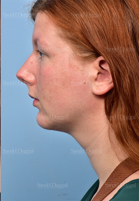 after chin liposuction side view female patient case 5365
