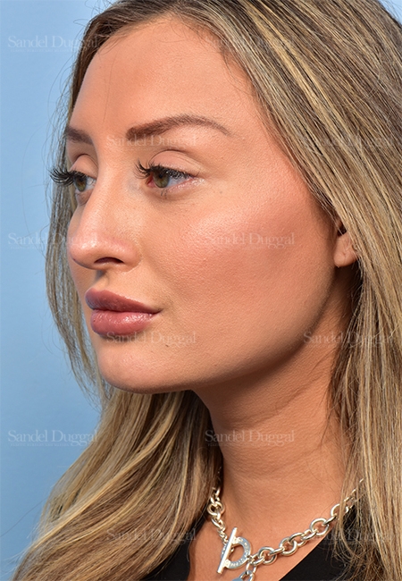 after non-surgical rhinoplasty angle view female patient case 5369