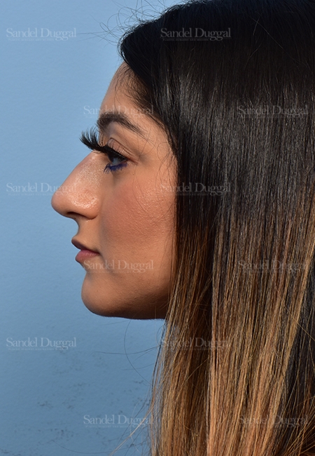 after non-surgical rhinoplasty side view female patient case 5372