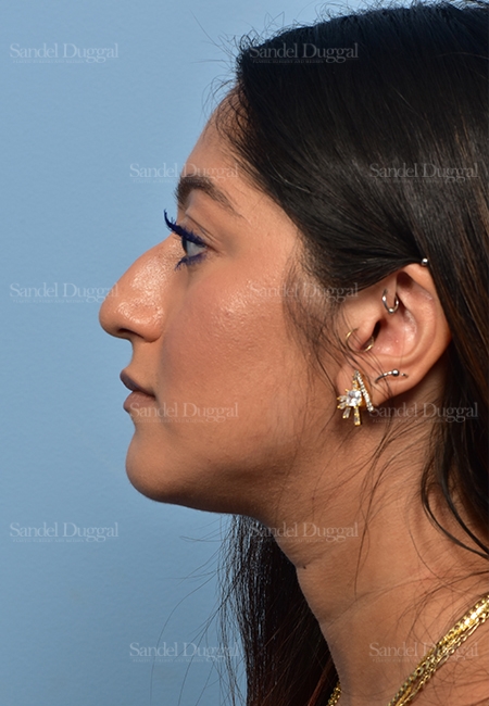 before non-surgical rhinoplasty side view female patient case 5372