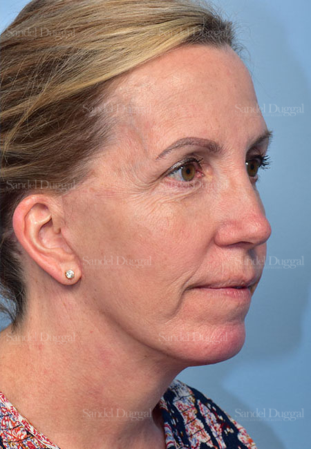 after facelift angle view female patient case 5686