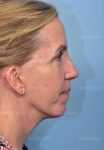 after facelift side view female patient case 5686