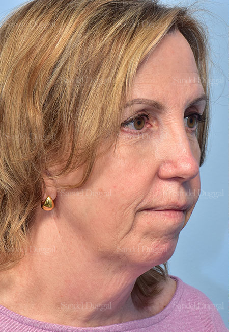 before facelift angle view female patient case 5686