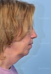 before facelift side view female patient case 5686