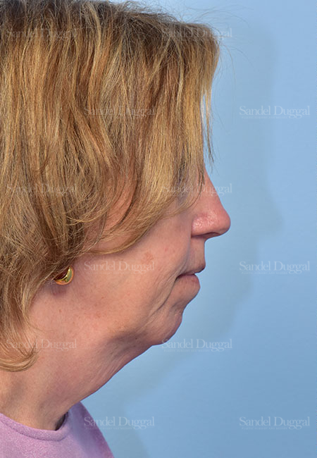 before facelift side view female patient case 5686