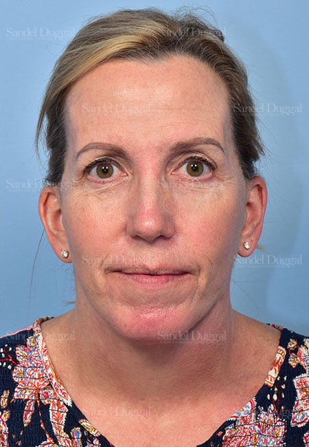 after facelift front view female patient case 5686