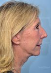 after facelift side view female patient case 5735