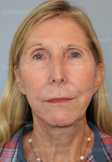 after facelift front view female patient case 5735