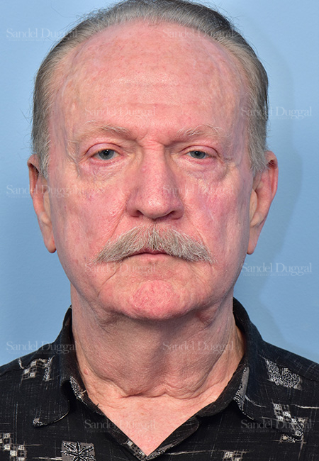 before facelift front view male patient case 5748