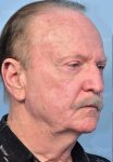 before facelift angle view male paitent case 5748