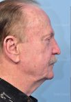 before facelift side view male patient case 5748
