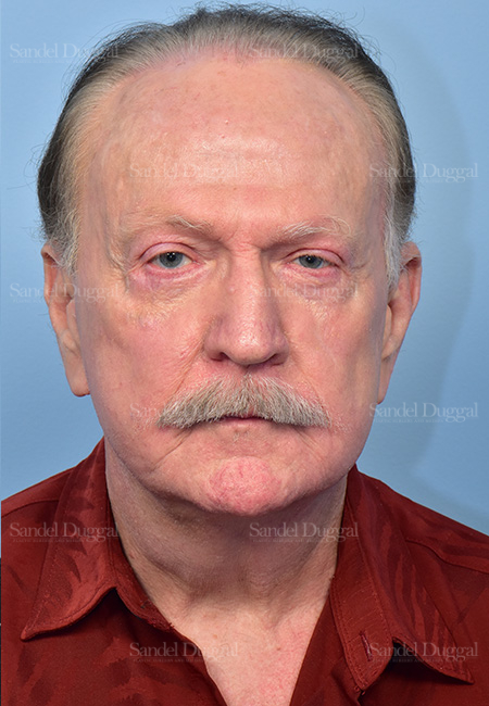 after facelift front view male patient case 5748