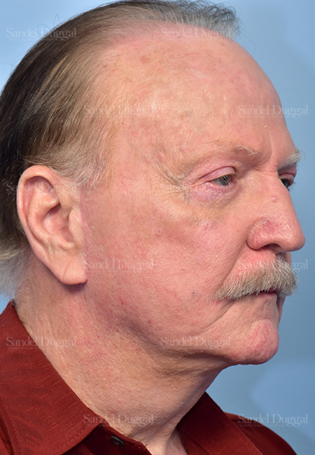 after facelift angle view male paitent case 5748