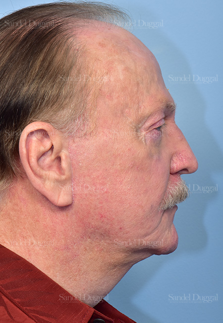 after facelift side view male patient case 5748