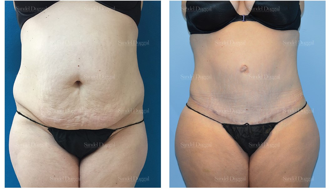 before and after tummy tuck front view view Annapolis