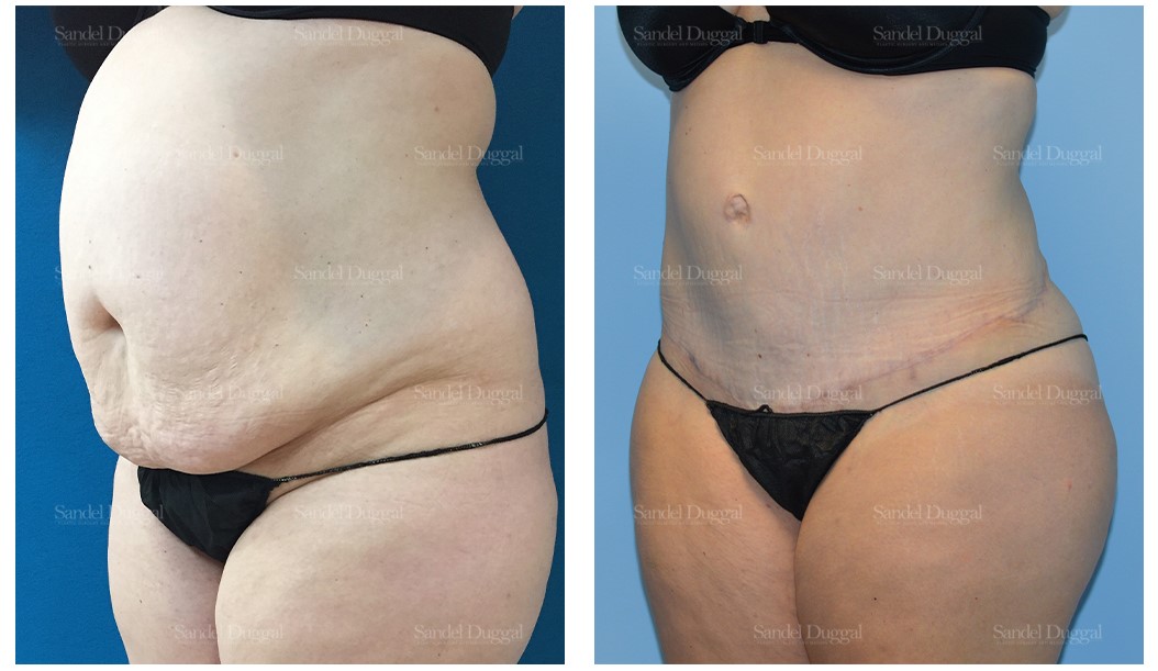 before and after tummy tuck left angle view sandel duggal